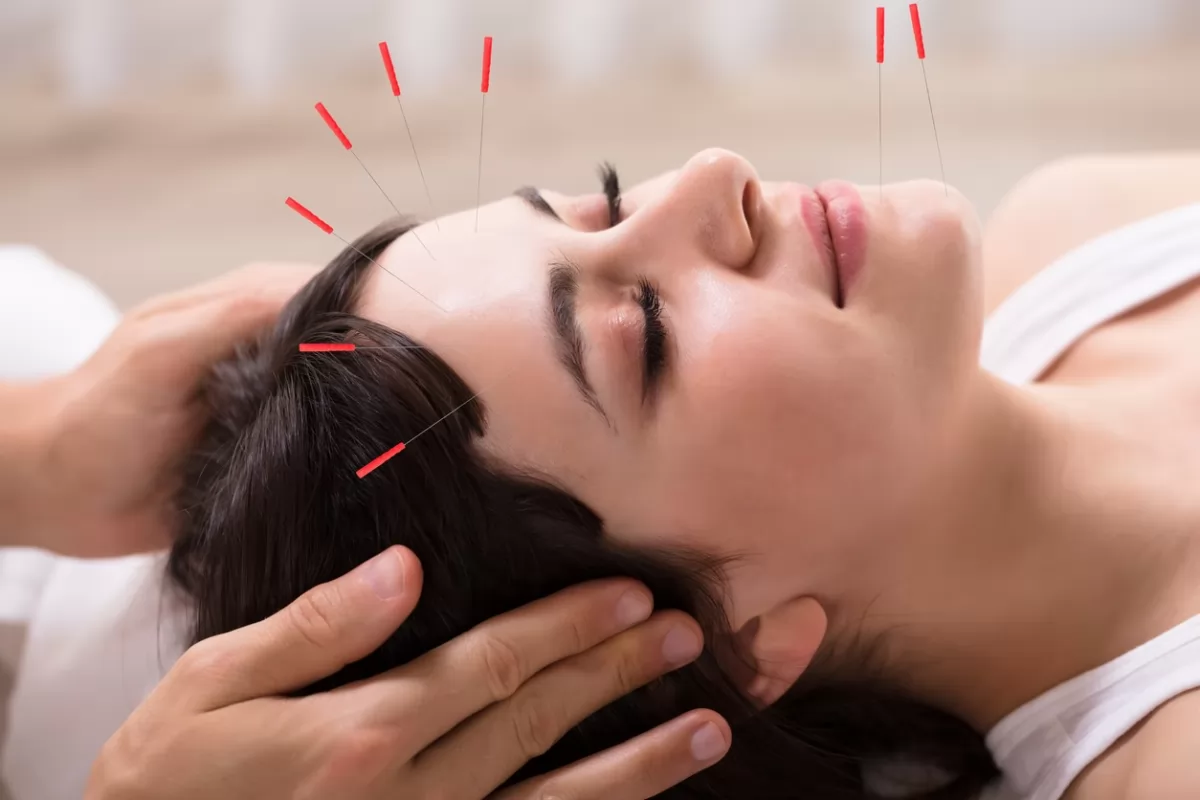 Châm cứu có thể điều trị rụng tóc hói đầu ở nam và nữ được không?