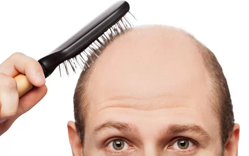 Vì sao nên sử dụng tóc giả cho người hói? 7 loại tóc giả che hói phổ biến nhất hiện nay