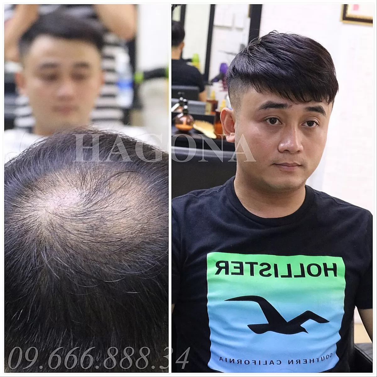 tóc giả mái hói nam bằng tóc thật