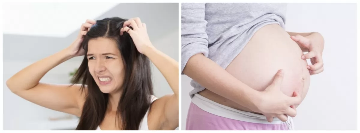 Nguyên nhân và cách điều trị ngứa da đầu khi mang thai