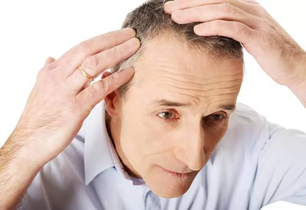 Tìm hiểu về bệnh rụng tóc ở nam giới