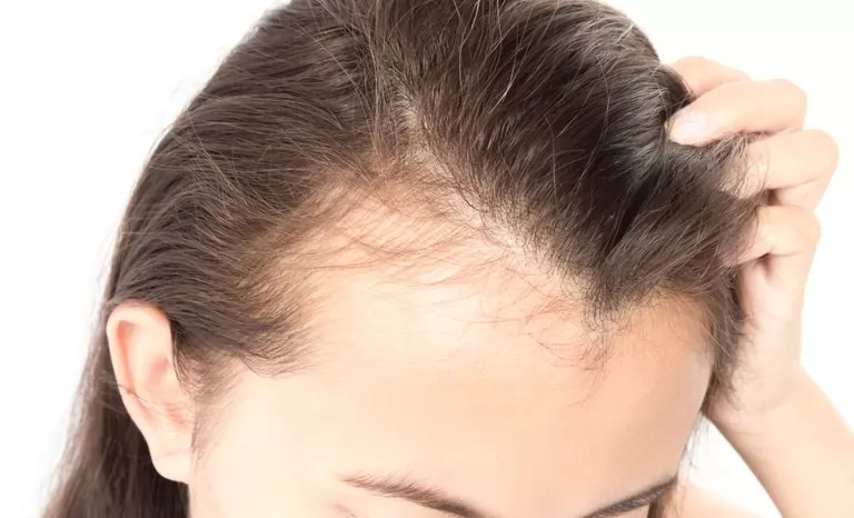 rụng tóc trung niên