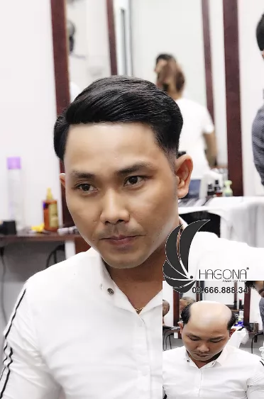 kiểu tóc cho nam hói 2 bên 3