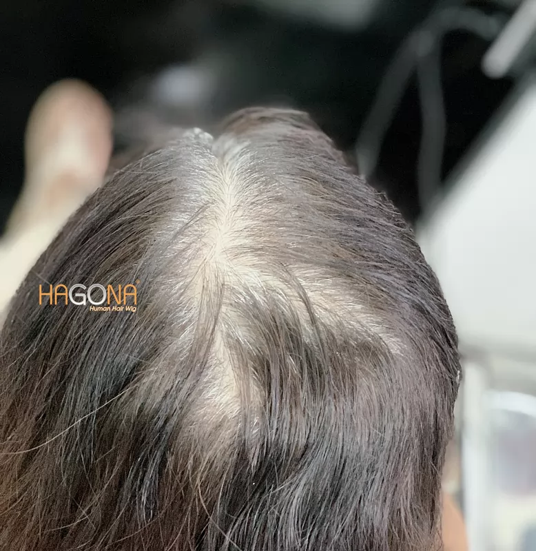 Tóc giả che hói HGN H02