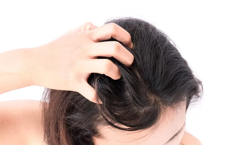 Trị gàu: 5 triệu chứng của tóc gàu và cách điều điều trị cơ bản