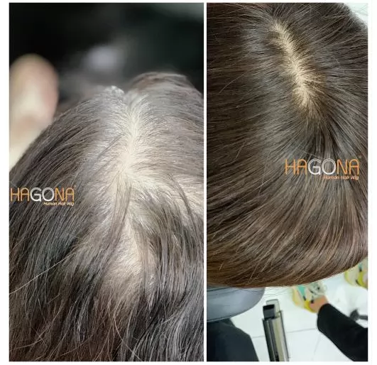 Tóc giả che hói HGN H02 Hagona