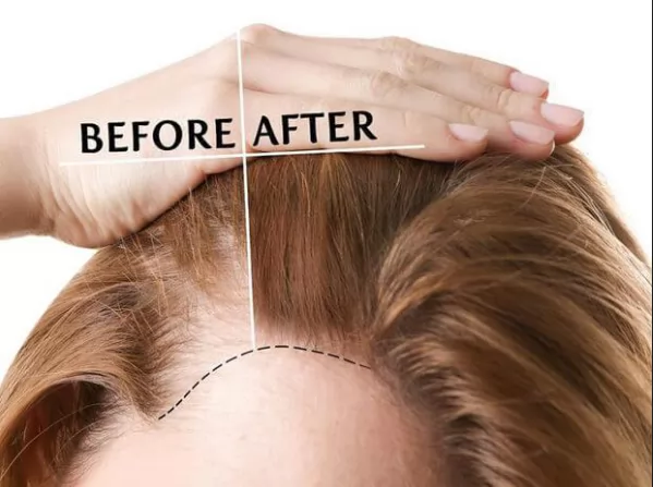 Tác dụng phụ của việc cấy tóc bạn phải biết