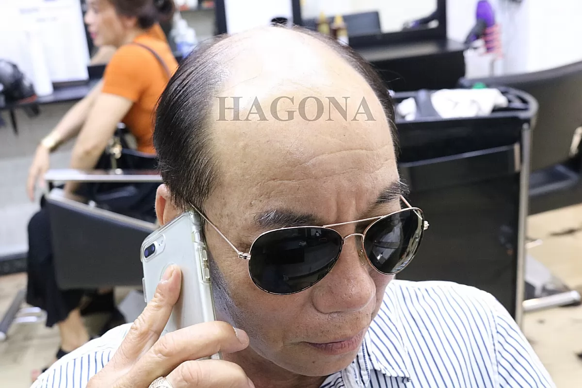miếng dán tóc giả nam