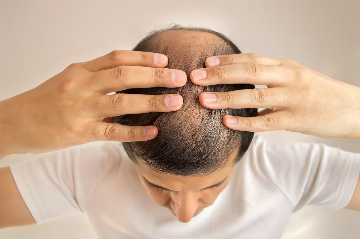 Tóc rụng nhiều ở nam giới là hiện tượng gì?