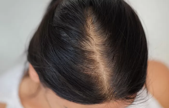 Tóc Rụng Rụng Ở Đỉnh Đầu: Nguyên Nhân Và Cách Khắc Phục
