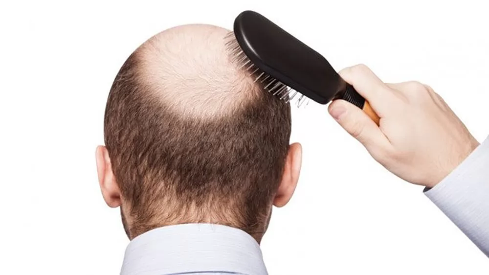 Nguyên nhân hói đầu sớm càng trở nên phổ biến?