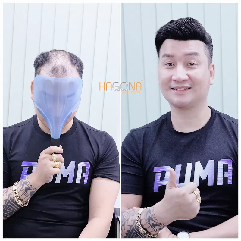 kiểu tóc cho nam trán hói 1