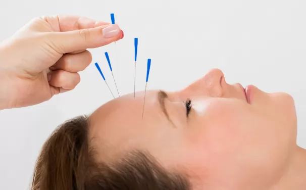 Châm cứu có thể điều trị rụng tóc hói đầu ở nam và nữ được không?