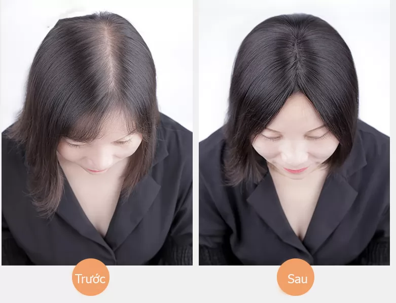 So sánh trước và sau khi bổ sung phần tóc ở vùng đỉnh