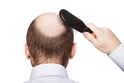 Bị hói đầu phải làm sao 1