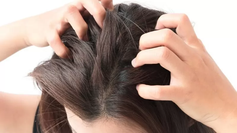14 cách trị ngứa da đầu từ thiên nhiên tại nhà