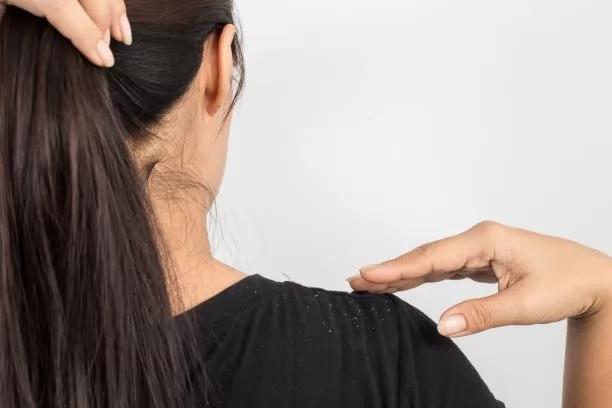 5 câu hỏi thường gặp về gàu được chuyên gia giải đáp