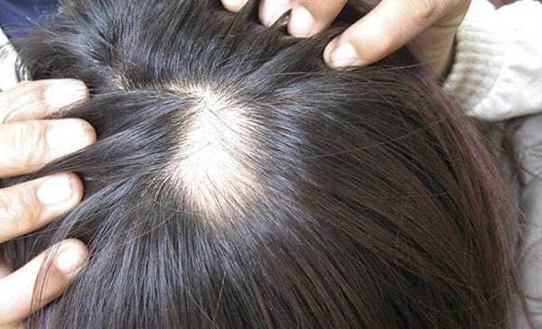 Bệnh rụng tóc hói đầu ở nữ giới