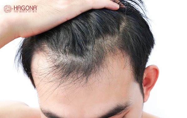 bệnh rụng tóc ở nam giới là bệnh gì