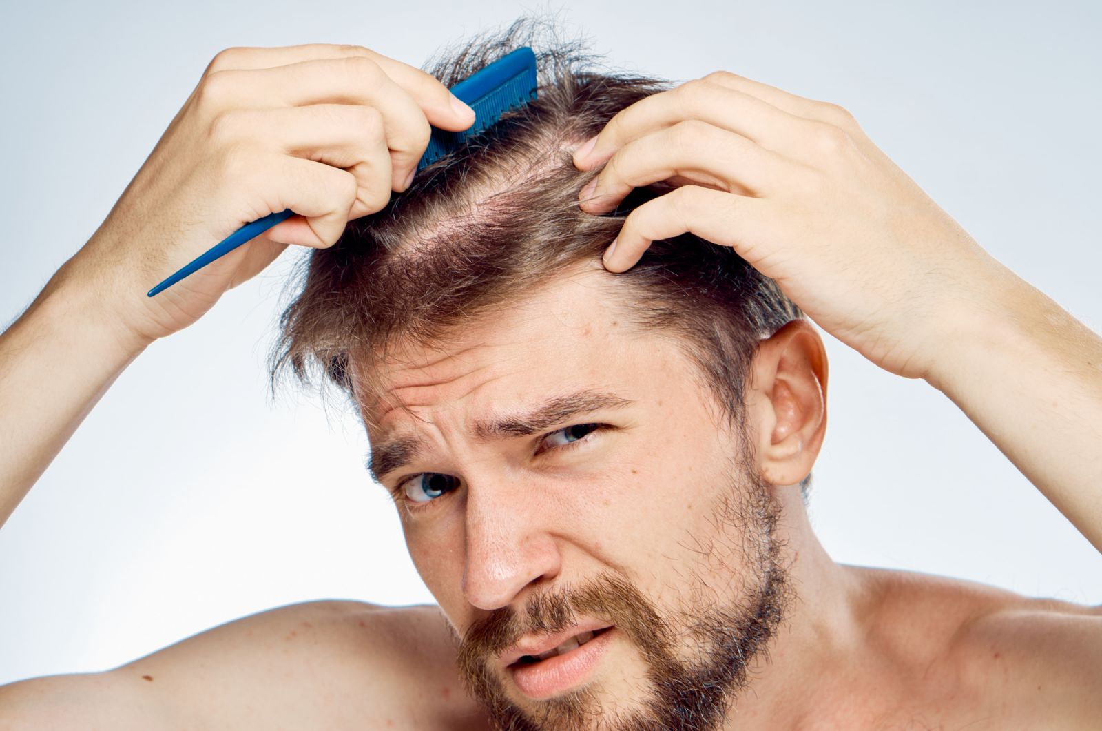 Nguyên nhân tóc nam giới bị khô xơ và cách trị tóc khô gãy hiệu quả