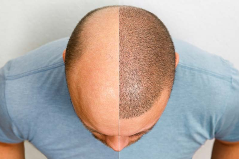 Cấy tóc sinh học là gì và có thực sự hiệu quả không?