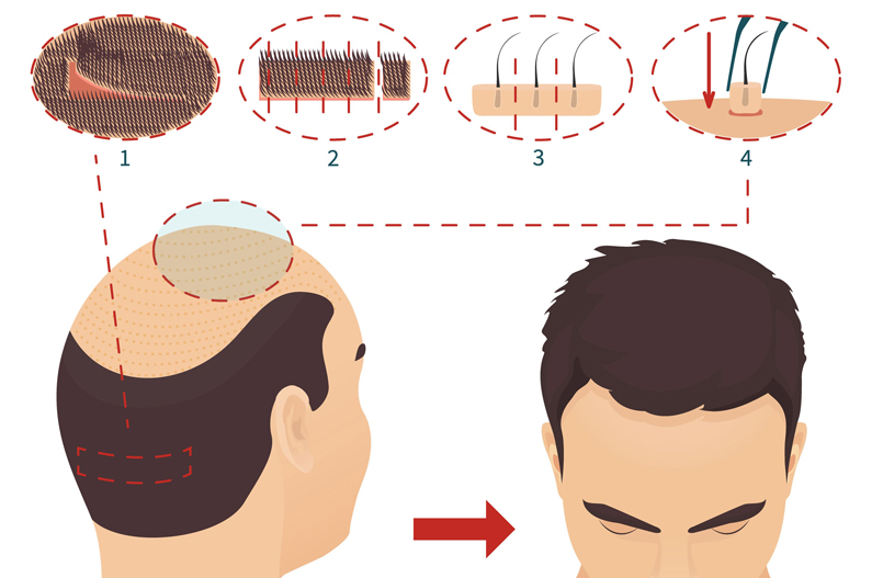 Sự khác nhau giữa cấy tóc tự thân và cấy tóc sinh học