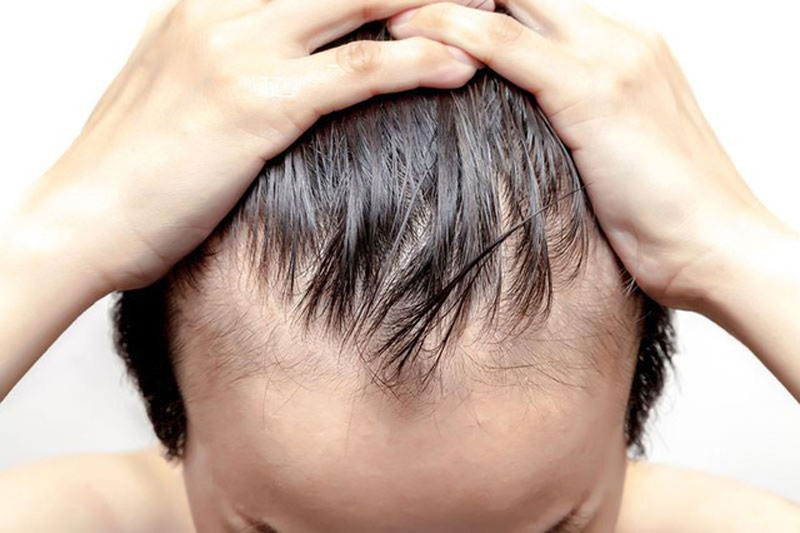 Phương pháp cấy tóc chữ M tăng vẻ nam tính cho nam giới
