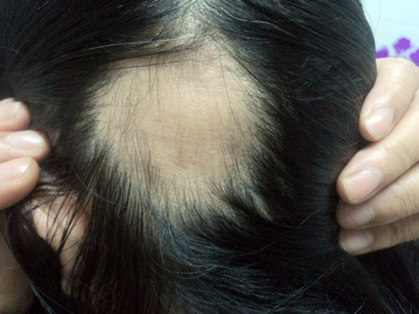 rụng tóc đỉnh đầu areata