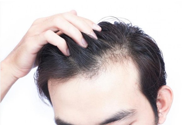 3 lý do chính dẫn đến hiện tượng rụng tóc sớm ở nam giới 