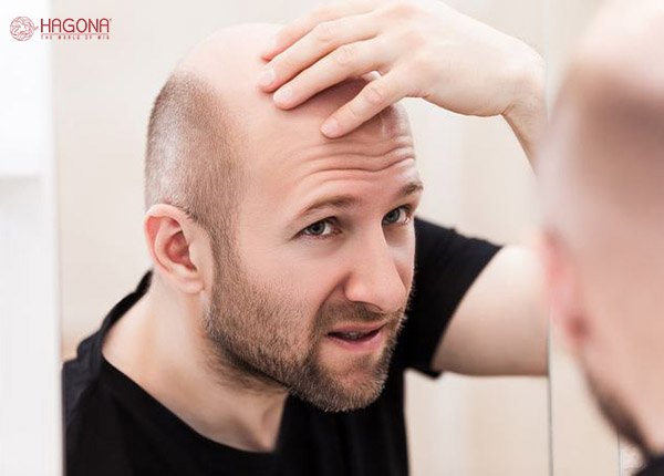 Nguyên nhân dẫn đến bệnh rụng tóc ở nam giới là gì?