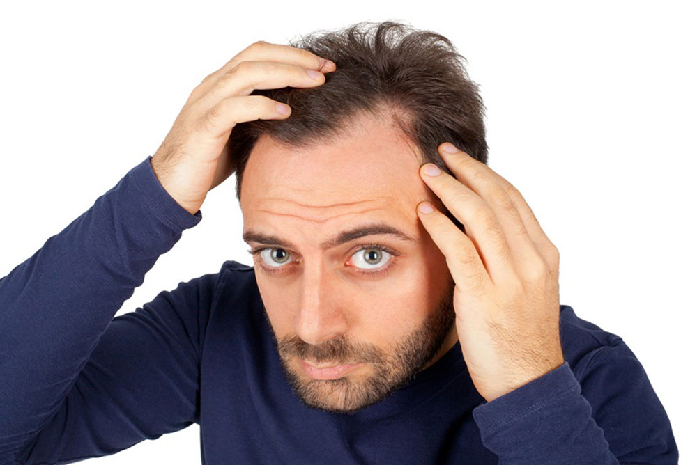 Tìm hiểu về bệnh rụng tóc ở nam giới 