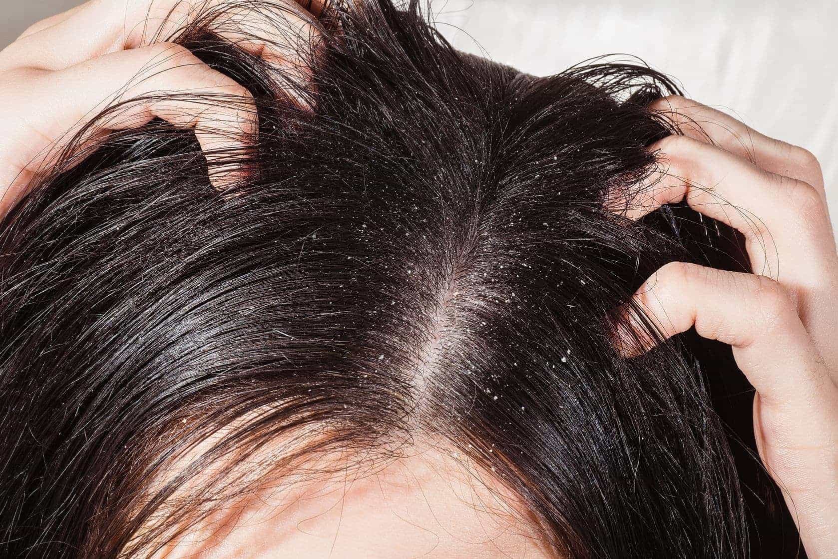 Trị gàu: 5 triệu chứng của tóc gàu và cách điều điều trị cơ bản