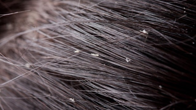 Gàu ướt là gì? 5 cách loại bỏ gàu ướt trên da đầu dầu nhờn
