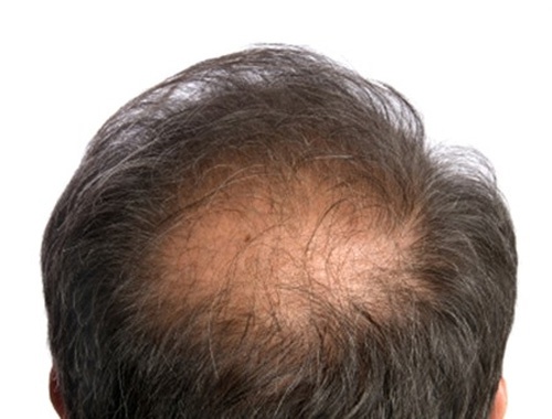 Hiện tượng rụng tóc đỉnh đầu và nguyên nhân 