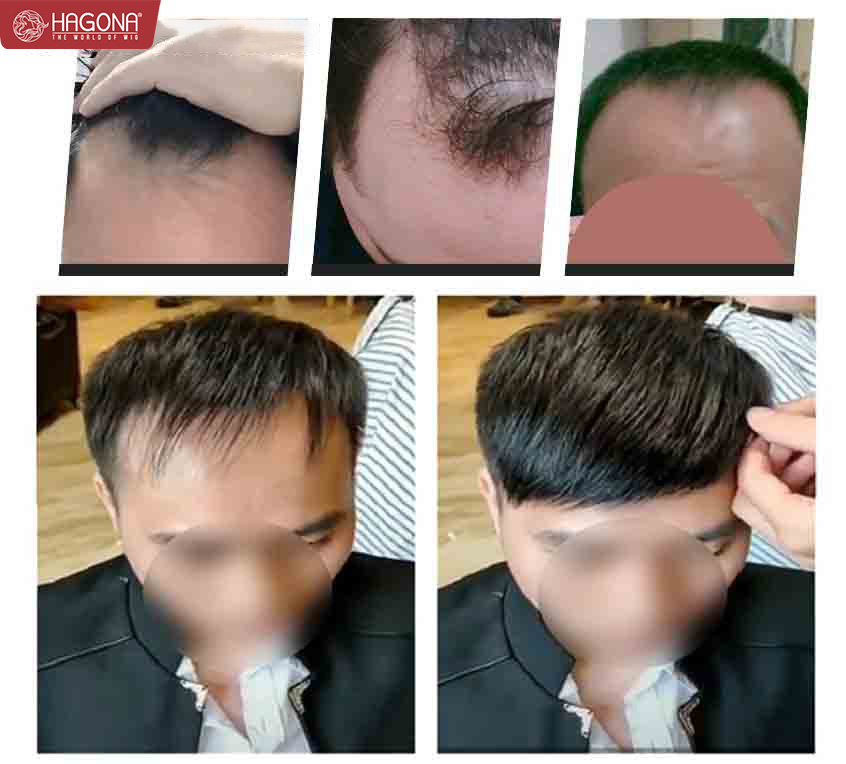 7+ kiểu tóc cho người hói chữ M giúp chàng “tút” lại vẻ đẹp trai